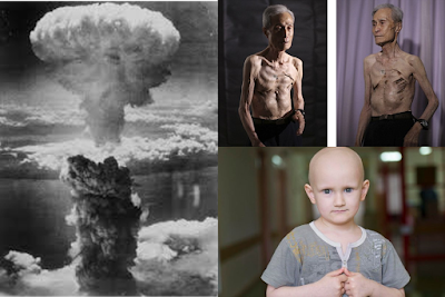Efectos de la Radioactividad en el ser humano. Arriba, paciente de Hiroshima. Abajo, víctima de Chernóbil Efectos-de-la-Radioactividad-en-el-ser-humano