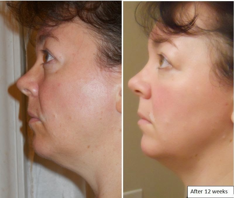 коллаген до после отзывы