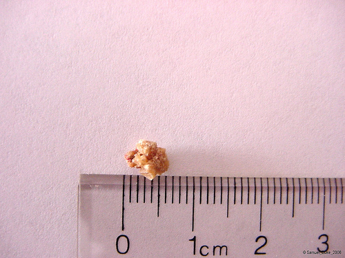 Kidney Stone Size Chart