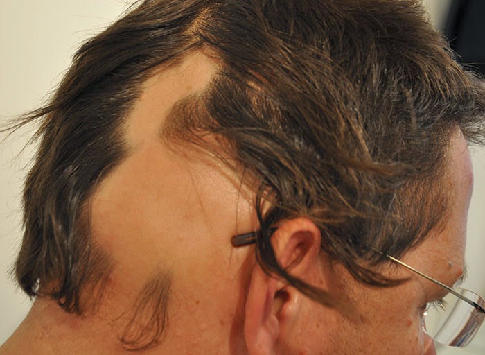 alopesi areata tedavisi