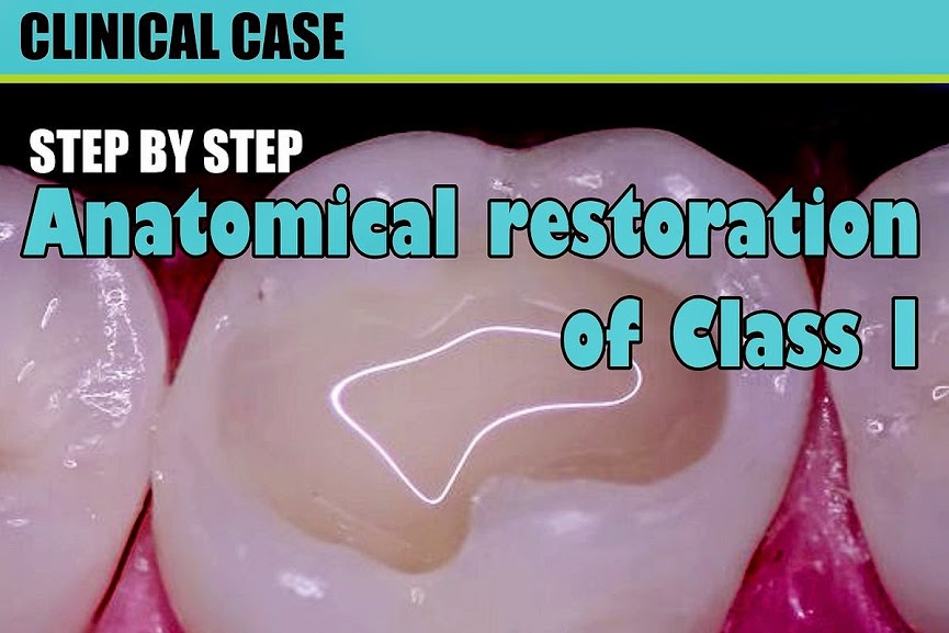 OPERATIVE DENTISTRY Anatomical restoration of class I step by step
