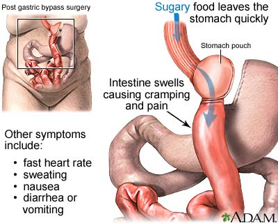 Dumping Syndrome Foods To Eat Dumping Syndrome Foods To Eat