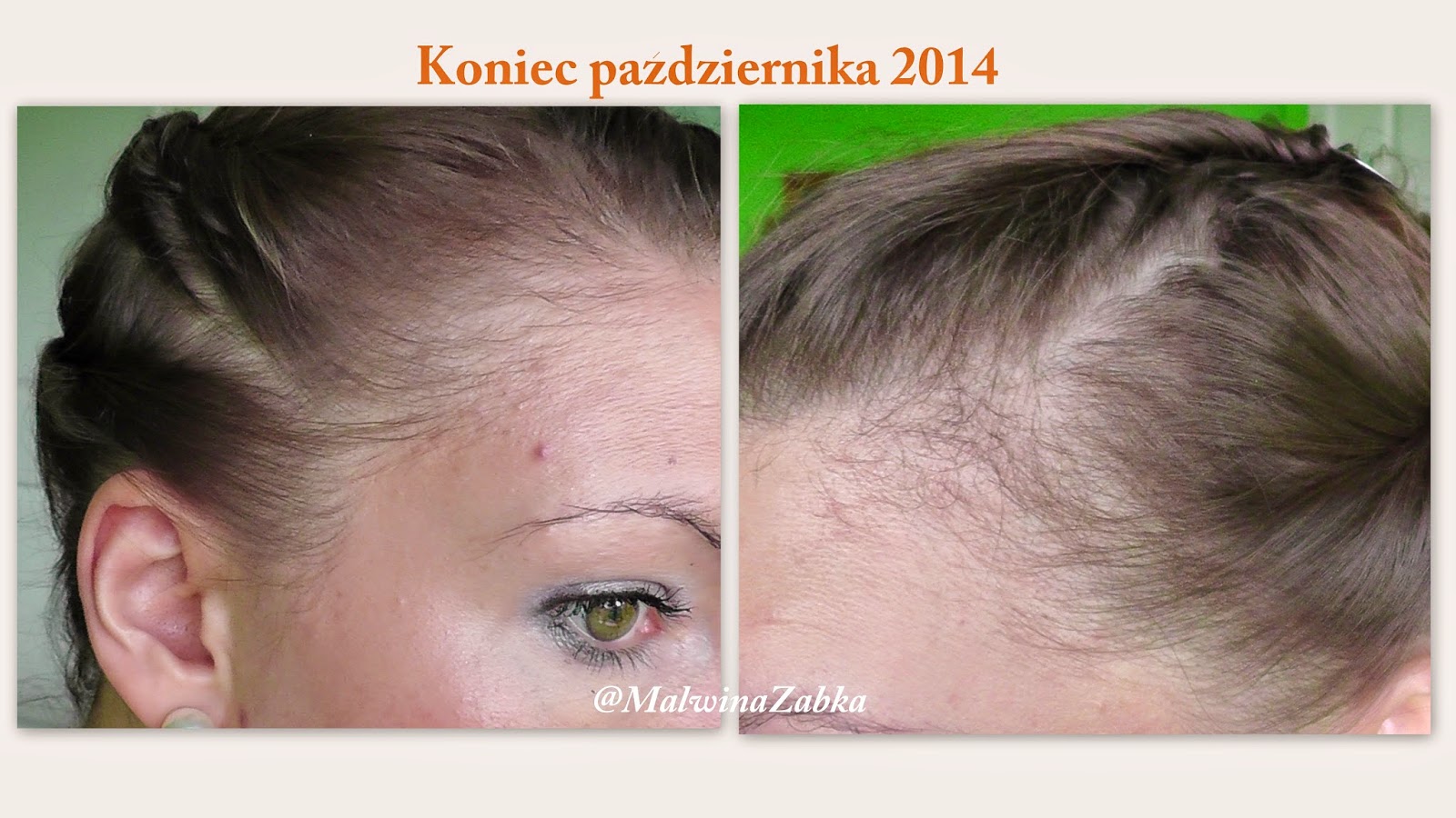 wypadanie włosów na diecie ketogenicznej