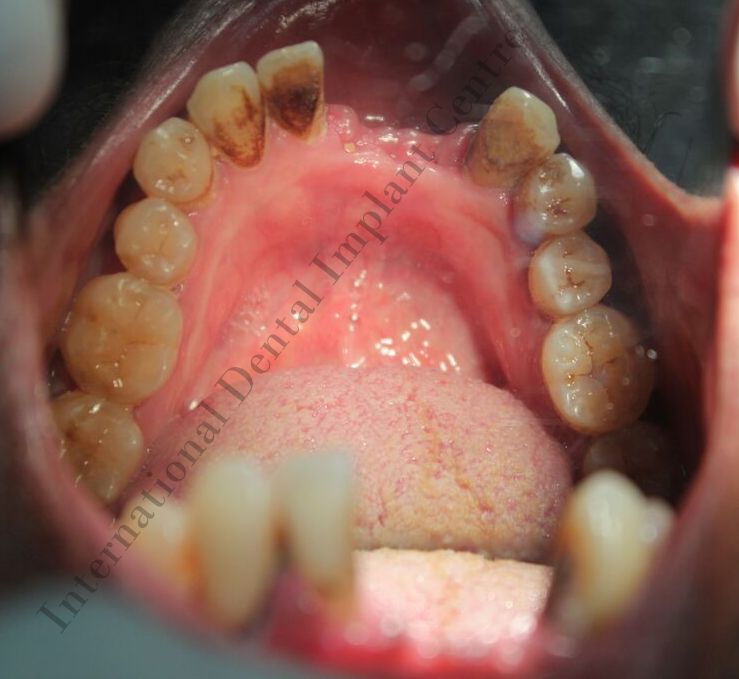 Best laser dental clinic Mugalivakkam Flapless Dental Implant with