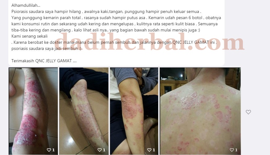 Cara Mengobati Penyakit Psoriasis Inverse, Vulgaris Royal Jelly Gamat QnC
