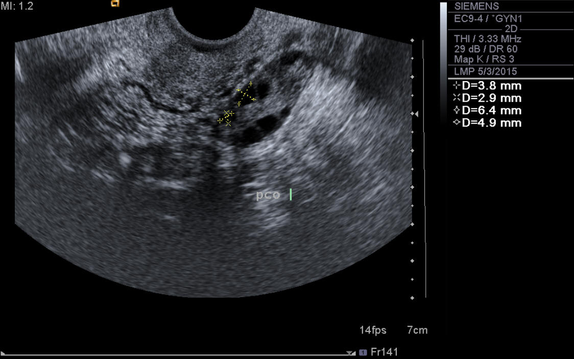 Pcos Ovary Ultrasound