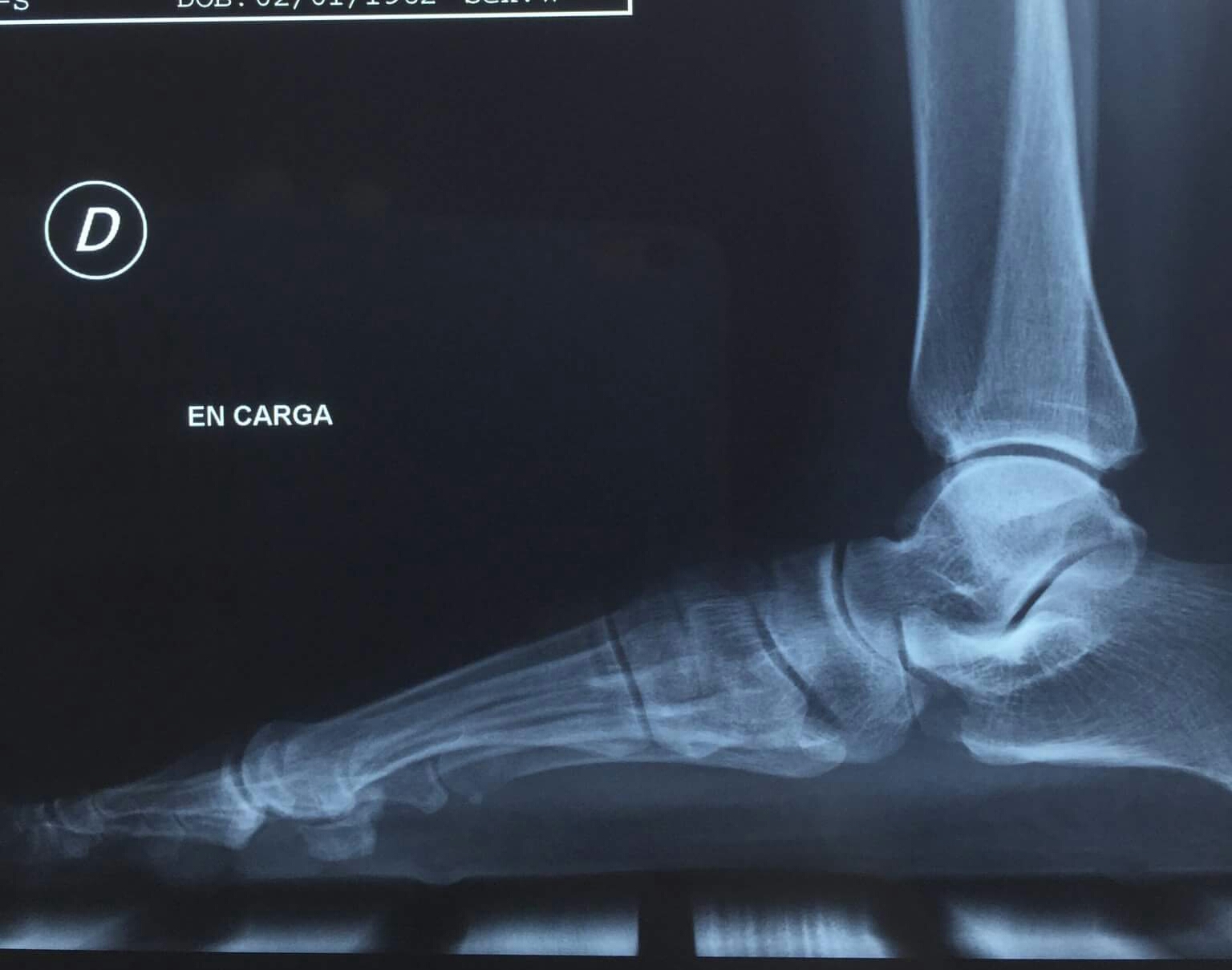 Podo Basas al Día Metatarsus primus elevatus. Uña incarnada (cirugía de onicocriptosis con fenol)