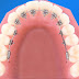 Niềng răng mặt trong giá bao nhiêu khi điều trị hô ?