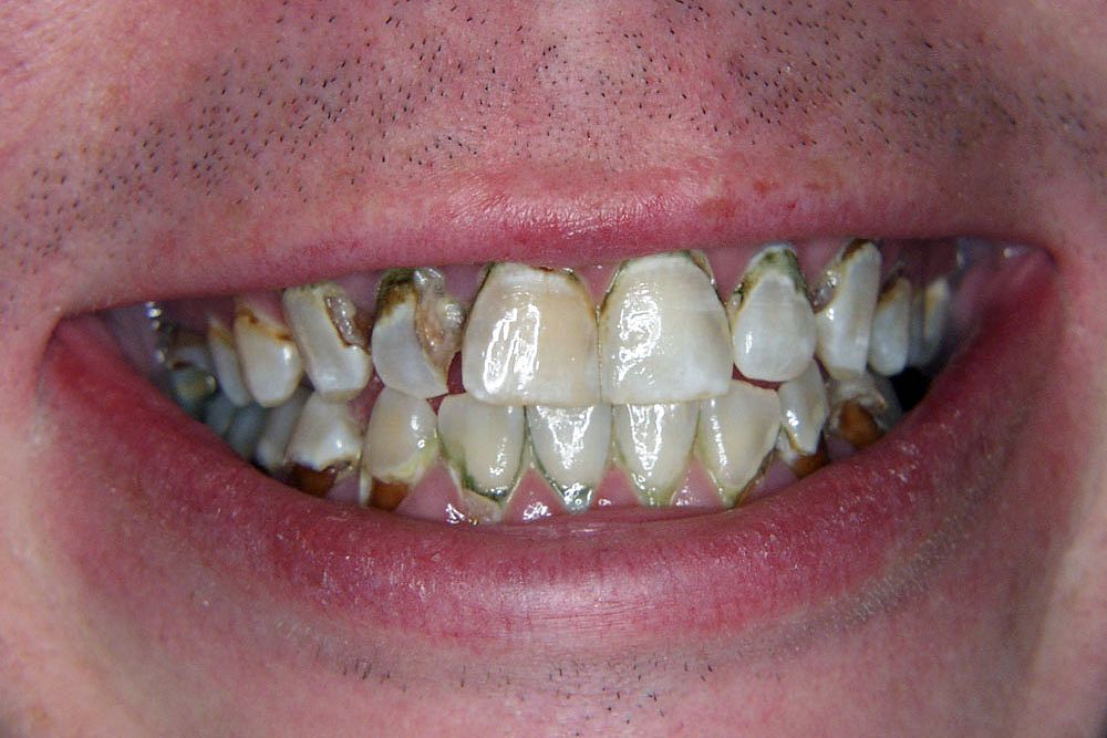 ORAL HEALTH How drug abuse drastically damages oral health