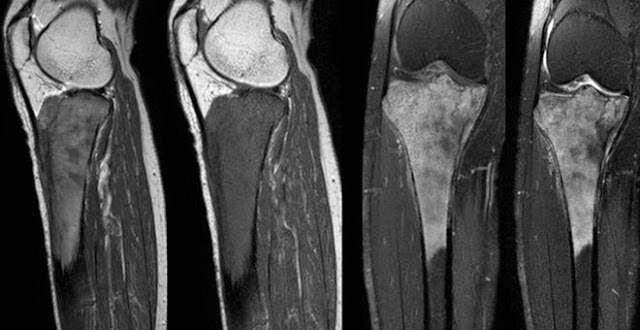 Οστεοσάρκωμα  Osteosarcoma