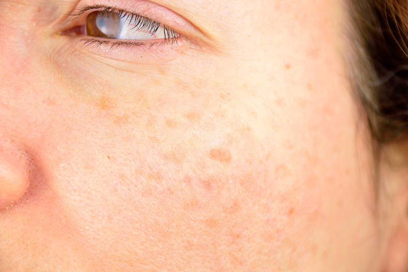 You'll develop age spots 12 Ways Smoking Cigarettes Ruins Your Looks