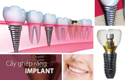 Độ tuổi cấy ghép răng Implant Nha khoa phù hợp