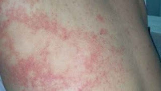 Bệnh mề đay nên chữa bằng thuốc Đông y