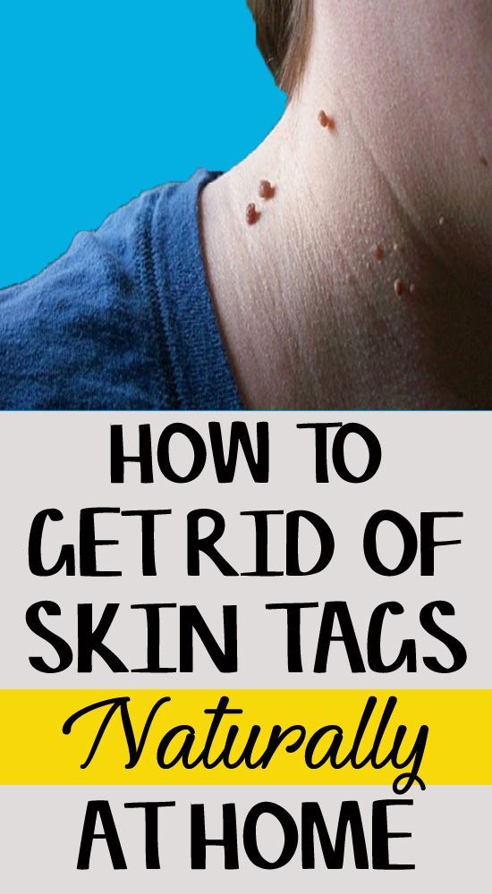 Best Remedies to Get Rid of Skin Tags Naturally