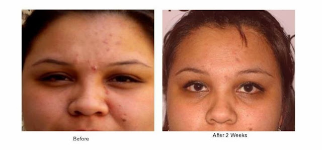 NuCerity Asia - Skincerity: Skincerity and Acne Condition
