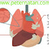MESOTHELIOMA CANCER: Deadly Cancer Without A Cure