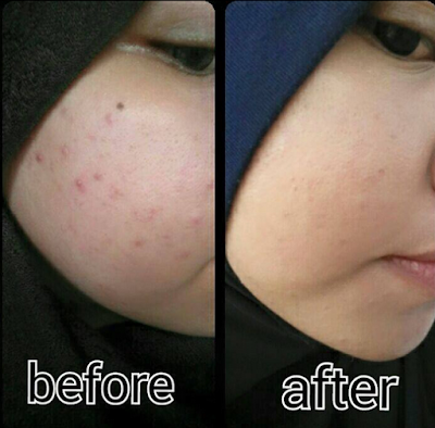 testimoni sabun pewitt