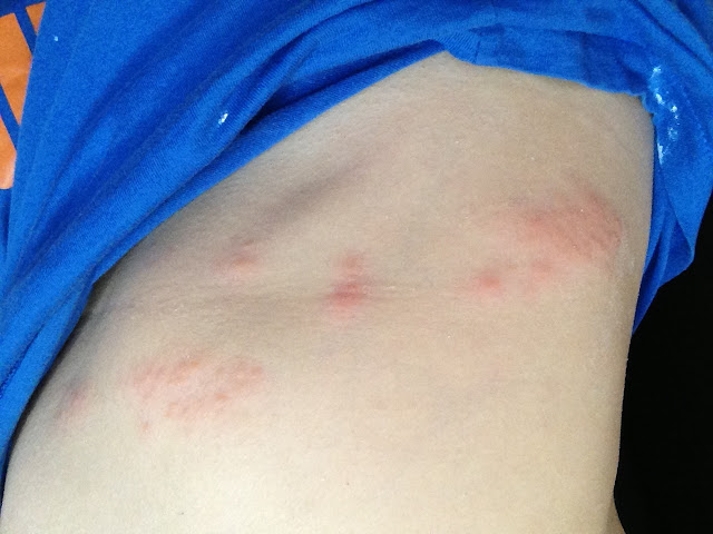 Bloop Blooop Bleeeeeep: Shingles - It starts with an itch...