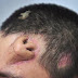 زراعة أنف لمريض في جبهته بالصين