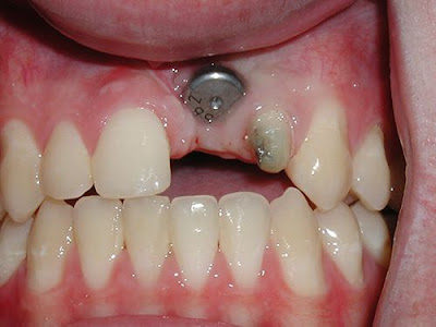 Trồng răng Implant giá bao nhiêu?