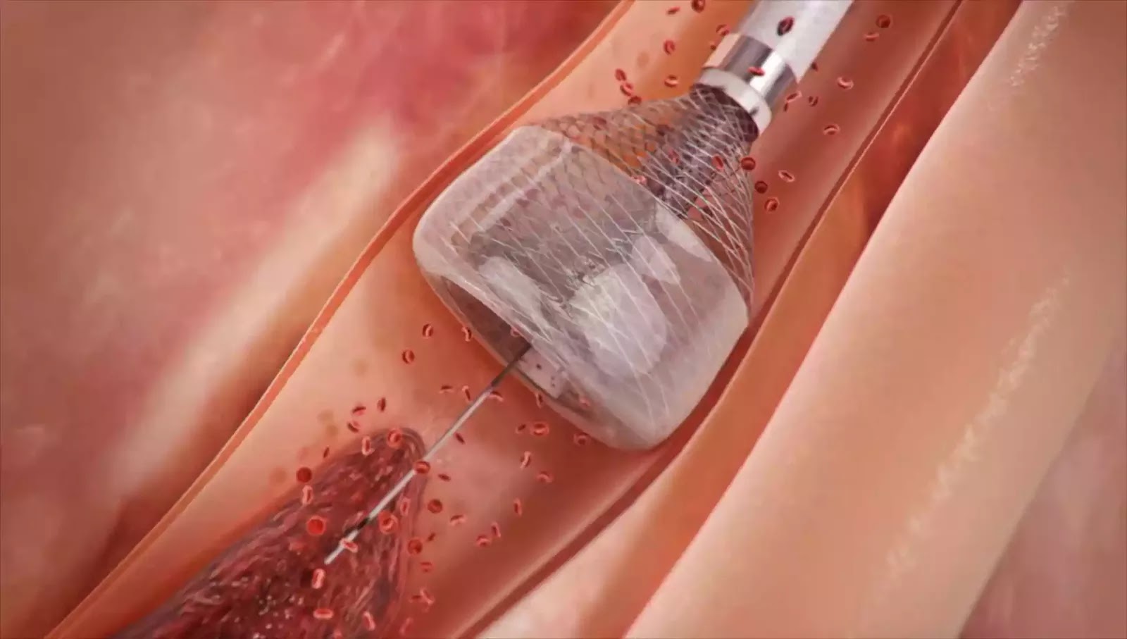 Amazing Science Coronary MegaVac Mechanical Thrombectomy System