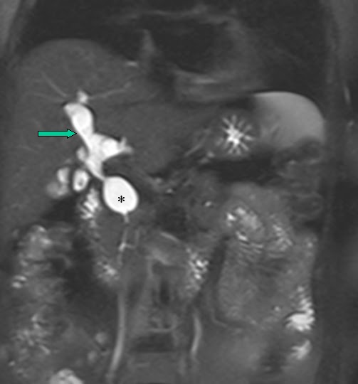 mricases Choledochal cyst Type IV MRI features