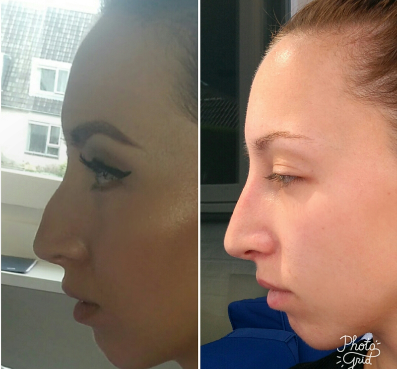 How My Non Surgical Nose Job Changed My Life - BLES Magazine - Beauty