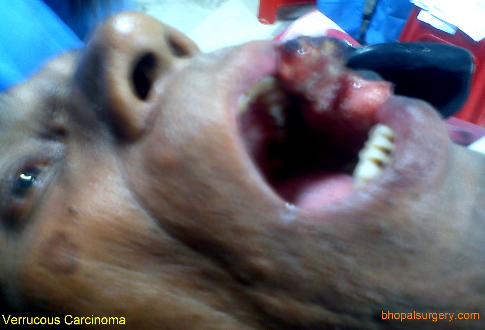Bhopal Surgery Photo Gallery Face and Neck Surgery