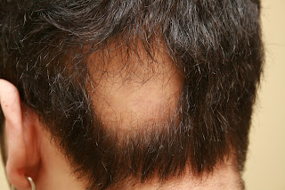 alopecia aureata