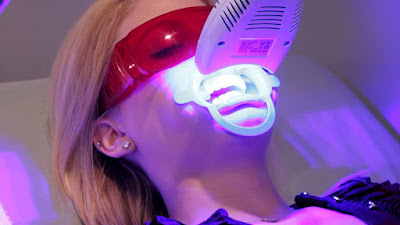 Tẩy trắng răng công nghệ Laser Whitening 
