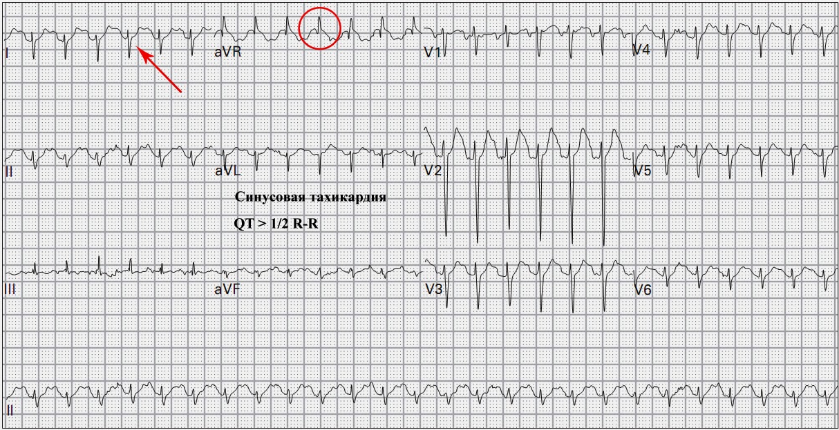 25 и 50 мм экг. трепетание предсердий с проведением 2 1. 10мм/мв 50мм/с экг фильтр изолинии. эос отклонена резко влево на экг. трепетание предсердий 1 к 1 на экг.