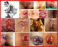 Foto OBAT HERBAL BAB BERDARAH ALAMI