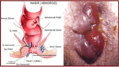 Foto Nama Obat Pencegahan Hemoroid Intenal Dan Ekstenal Yang Paling Laris