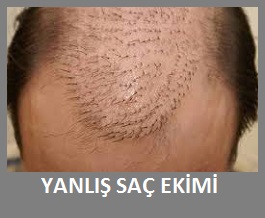 Yanlis Sac Ekimi Duzeltme Operasyonlari Sac Ekimi Destek