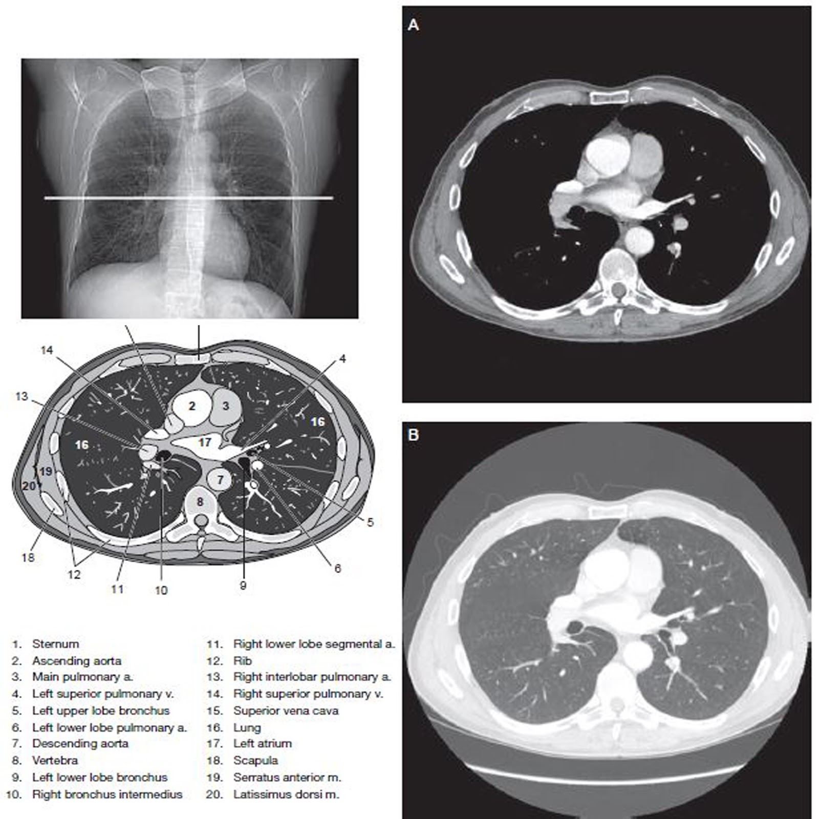 Chest Ct Scan With Contrast Indications Ct Scan Machine
