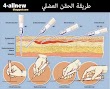 تعلم طريقة الحقن العضلي | Learn how to intramuscular injection