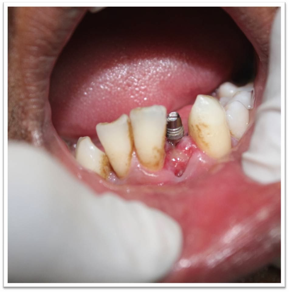 Zirconia crown cementation in indiafor lower front tooth implant