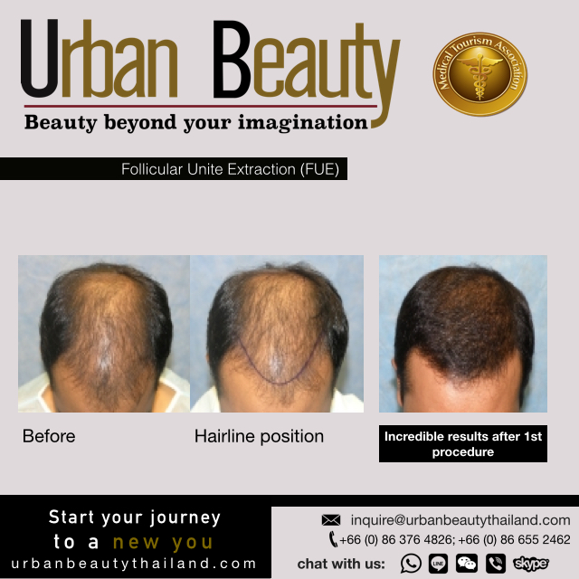 Best Hair Transplant in Bangkok Thailand