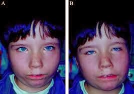 moebius syndrome understanding treatment medical better before after
