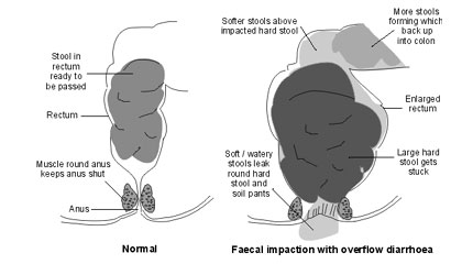 Constipation: Old Folk Remedy To Help You Overcome Hard Stool