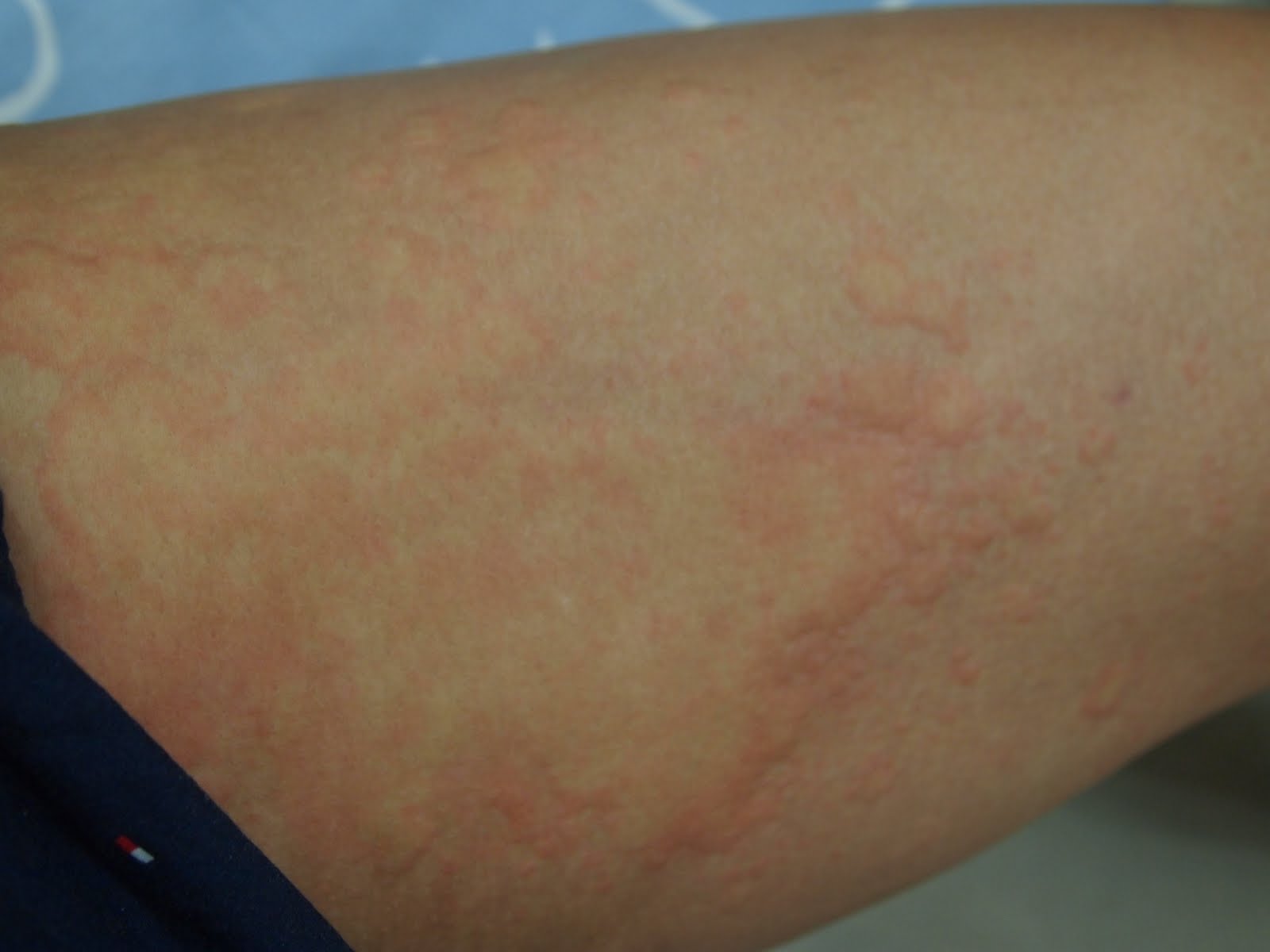 Locky's English Playground Medical & Vocabulary "Hives" & Allergy