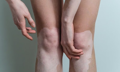 ayurveda treatment for vitiligo in delhi