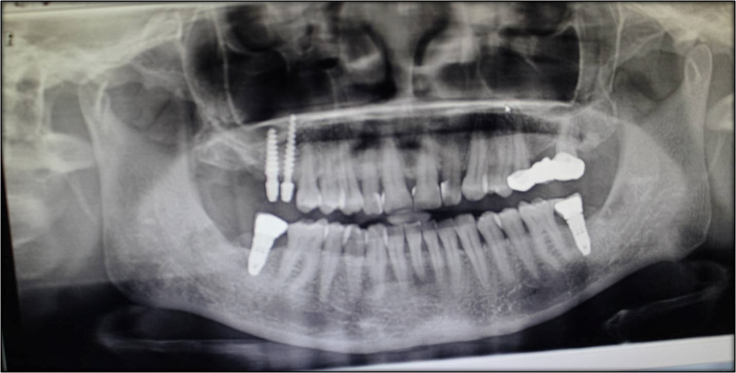 Dental implants without bone grafts in maxillary sinus region