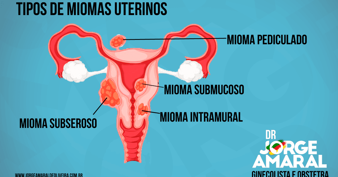 Tipos de Miomas Uterinos Tipos de Miomas Uterinos
