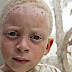 Paquete de piezas de albino se paga hasta en 75,000 dólares en Tanzania