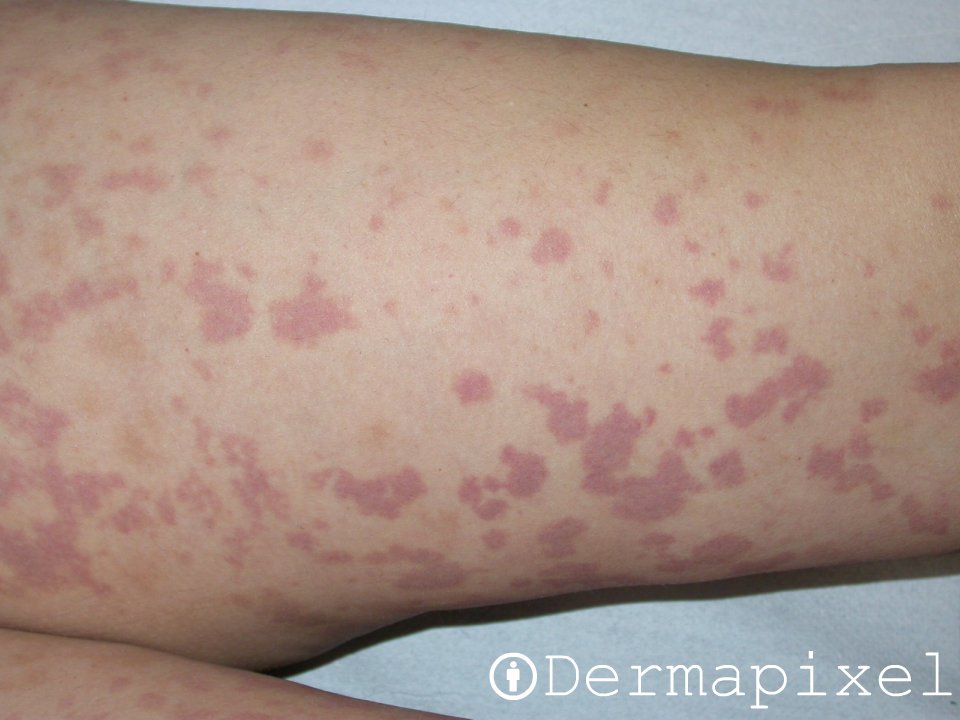 orticaria vasculitica pdf