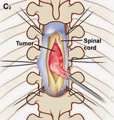 SPINAL CORD TUMOR