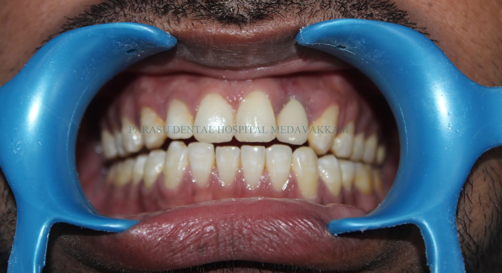 dental implants cost in chennai,India Fixed solution for teeth replacement