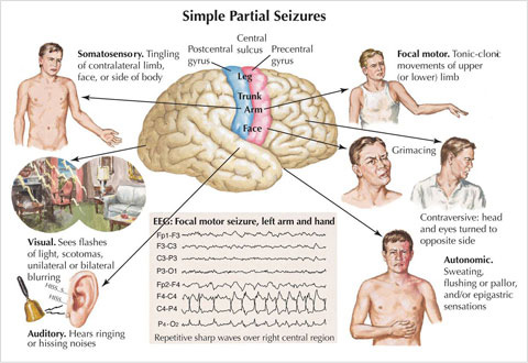 seizures seizure homeopathy epilepsy epileptic ajays