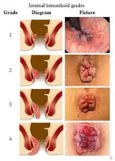 obat tradisional ambeien parah